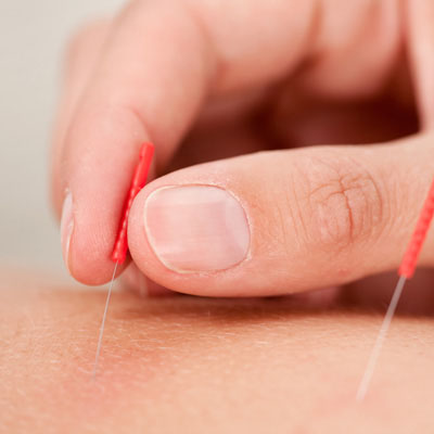 Chiropractic Torrance CA Acupuncture Service