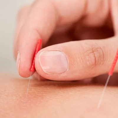 Chiropractic Torrance CA Acupuncture Service