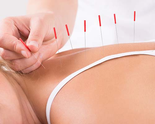 Chiropractic Torrance CA Acupuncture