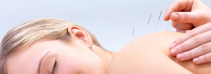 Chiropractic Torrance CA Acupuncture Acupuncture needles in a patients shoulder.